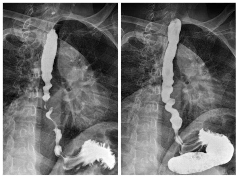 Radiopaedia's tweet photo. Q: 65yo man with dysphagia. What's the diagnosis and what is the appearance likened to?
ANSWER: https://t.co/tChrL0QHxz
#FOAMrad #FOAMed https://t.co/MbIpC8dEa1