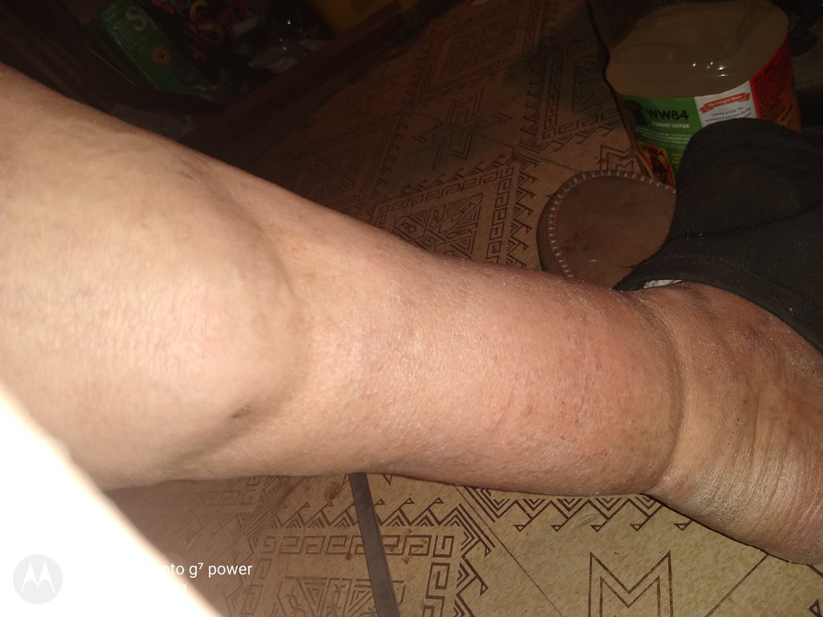 eriverad55's tweet photo. @IntlCrimCourt need investigations into radio frequency torture by united states government, especially @FBI. Leg burned by R. F. Torture https://t.co/MYi31XcQVi