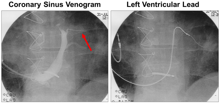 cardioscanAU's tweet photo. This week, Dr Harry Mond explores #biventricular pacing, often referred to as simultaneous #depolarisation of the right and left #ventricles and how it's an indication for permanent #cardiac pacing. Read more: https://t.co/19DRBNk6hm #ECG #CardioTwitter #Epeeps https://t.co/RJTN6bLjJh