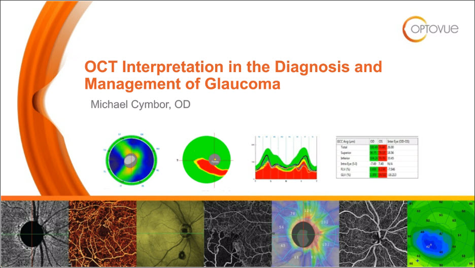 OptovueOCT's tweet photo. Hear glaucoma specialist Michael Cymbor present an on-demand webinar on How to Utilize OCT and OCTA in the Detection and Management of Glaucoma. https://t.co/hnBbExjXyj https://t.co/S3OqDtl2rs