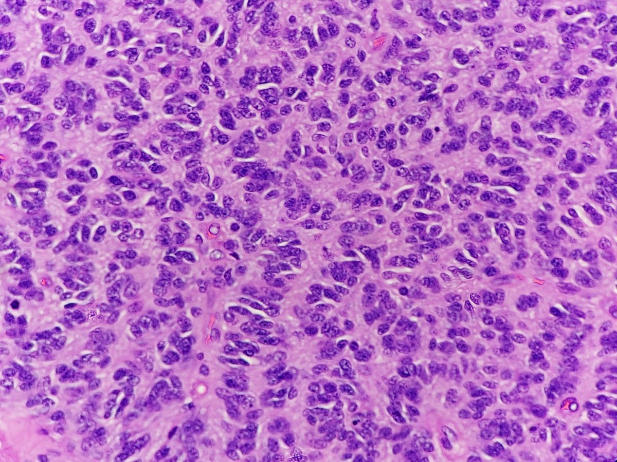 padmapathology1's tweet photo. “Rhythmic palisades” or a “spongioblastic pattern"
✍️exaggerated version containing many rows of aligned nuclei
✍️presence of rhythmic palisades of compactly packed bipolar cells that were thought to resemble radial glia during fetal development
#neuropath
#pathologists 
C/o ODG https://t.co/ByCtEPkMbD