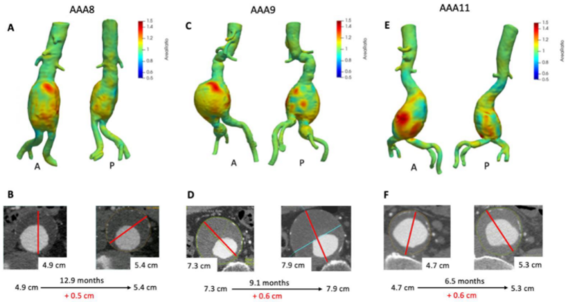 Congrats to <a href="/DrewBraetMD/">Drew J Braet</a> on the publication of this paper: 

Vascular Deformation Mapping of Abdominal Aortic Aneurysm

mdpi.com/2379-139X/7/2/…

Great collaboration across <a href="/umichCVC/">U-M Health Frankel CVC</a>, <a href="/UoMVascSurgery/">UoM Vascular Surgery</a>, <a href="/UMBME/">U-M BME</a> 

@nickburrisMD <a href="/yunahmedumich/">Yunus Ahmed</a> <a href="/BakelPieter/">Pieter van Bakel</a>