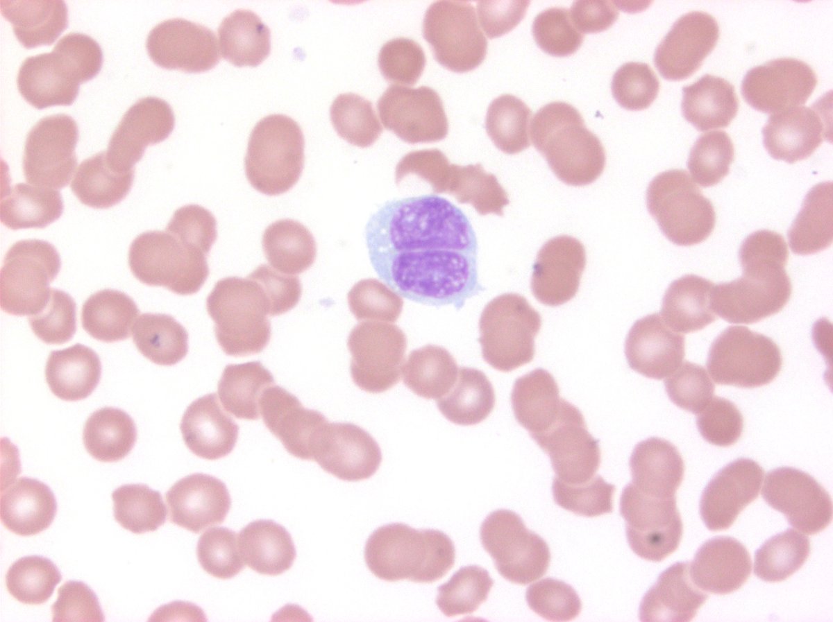 Some shots of hairy cell leukemia-variant, from my colleague Ants. CD103+, CD11c+; negative CD25. No BRAF. Positive TP53 mutation #hemepath