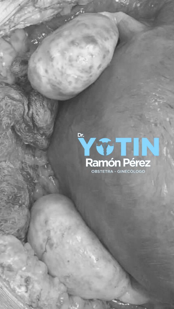 yotinperez's tweet image. Majestuosos e imponentes #Ovarios