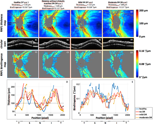 ARVOiovs's tweet photo. New and free to read: "Early Identification of Retinal #Neuropathy in Subclinical Diabetic Eyes by Reduced Birefringence of the Peripapillary Retinal Nerve Fiber Layer.”
 
https://t.co/SgPDhNlbyz #diabetes #retina #OCT #OpenAccess @MedUni_Wien https://t.co/MUF6UrcboJ
