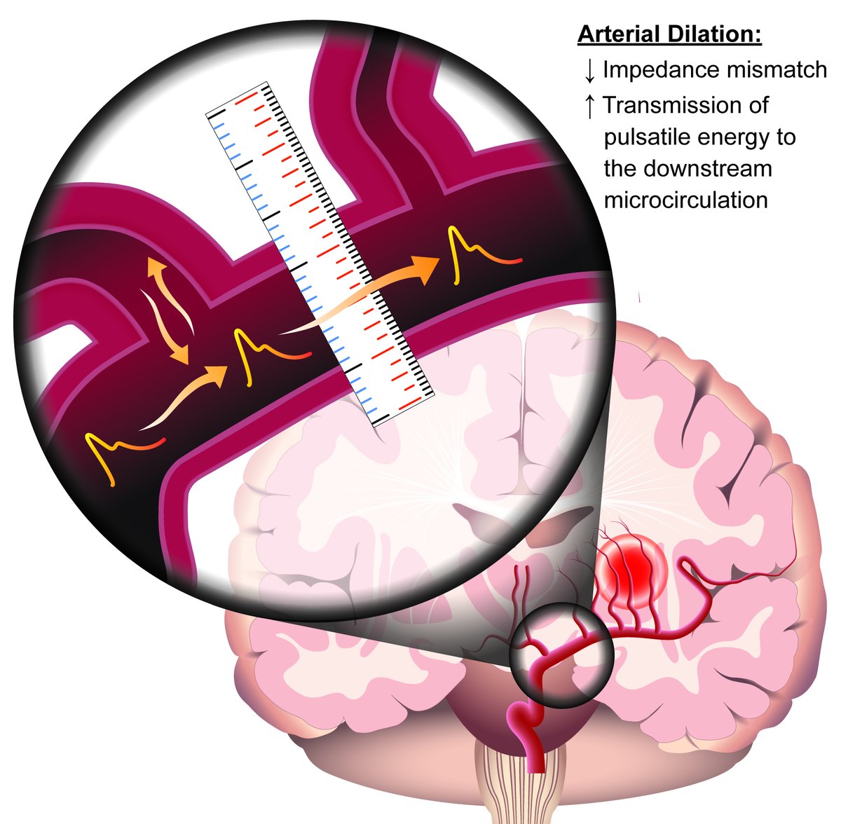 In older adults, brain MRI shows that MCA or ACA dilation, a risk for white matter hyperintensity, is amplified by central arterial stiffness.
<a href="/CaugheyPhD/">Melissa Caughey PhD</a> <a href="/qiaoyale/">Ye Qiao</a> <a href="/priyapalta/">priyapalta</a> <a href="/KuniMatsushita/">Kuni Matsushita</a> 

ow.ly/EiCH50EM8yc