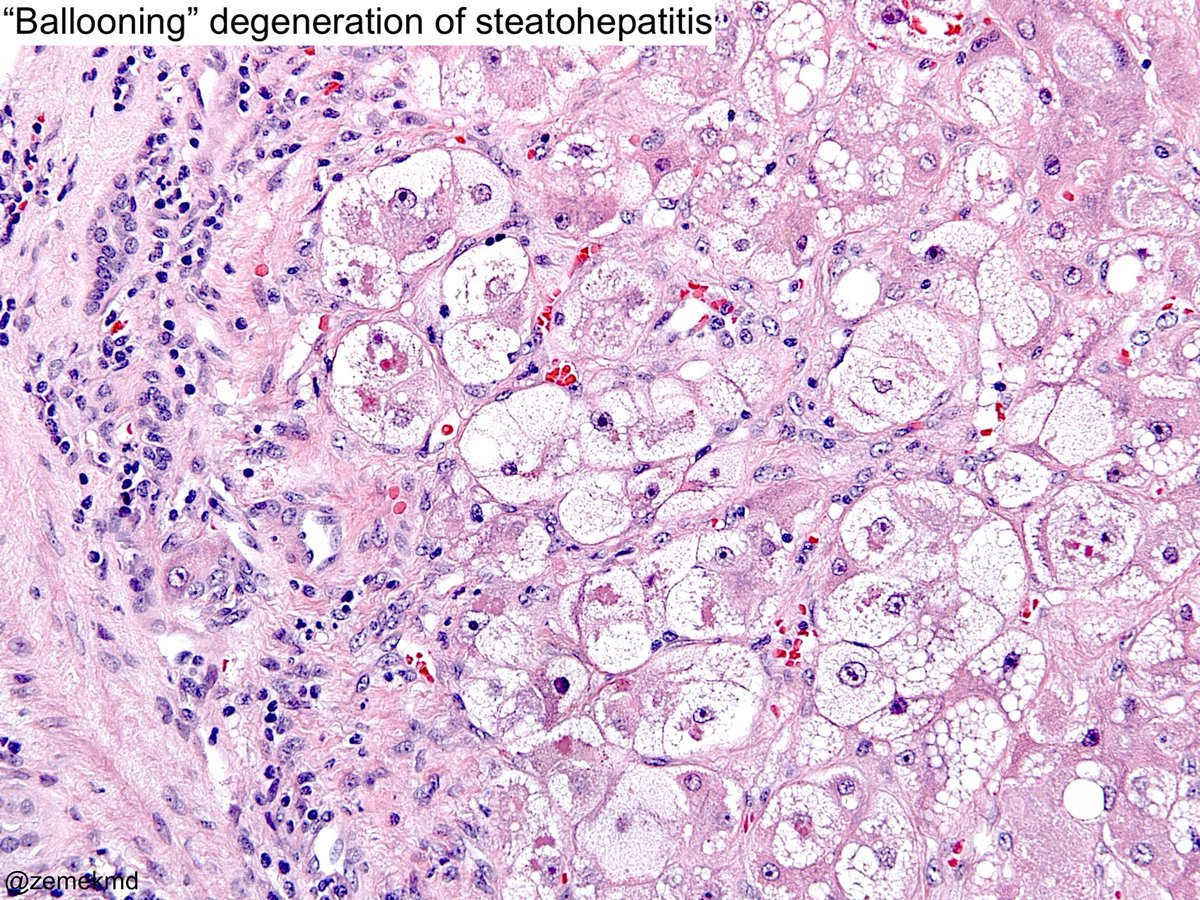 zemekmd's tweet photo. "Feathery" vs "Ballooning" degeneration:

Similarities: Overlapping features of swollen, enlarged &amp; injured hepatocytes with cytoplasmic reticulation.

Differences: Ballooning-Steatohepatitis, mallory-denk, glycogenated nuclei. Feathery-Cholestasis

#gipath #pathology #histology https://t.co/byrIVOMiau