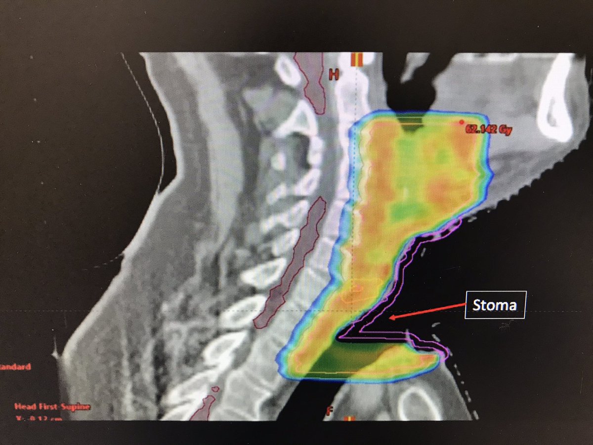 Dr Margaret Coffey (@mmcoffeystamp) on Twitter photo Thank you to Dorothy Gujral, Clinical Oncologist for a very stimulating presentation and subsequent discussion on the oncological treatment of laryngeal cancer #ICLlary21 @Imperialpeople <a href="/ImperialSandC/">Surgery and Cancer</a> <a href="/ImperialCPD/">Imperial CPD</a> Thank you to Dorothy Gujral, Clinical Oncologist for a very stimulating presentation and subsequent discussion on the oncological treatment of laryngeal cancer #ICLlary21 @Imperialpeople <a href="/ImperialSandC/">Surgery and Cancer</a> <a href="/ImperialCPD/">Imperial CPD</a>