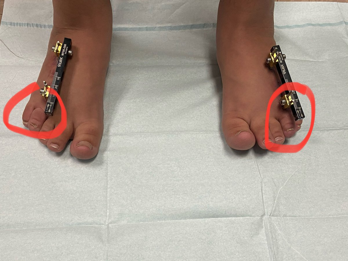 Brachymetatarsia Hashtag On Twitter