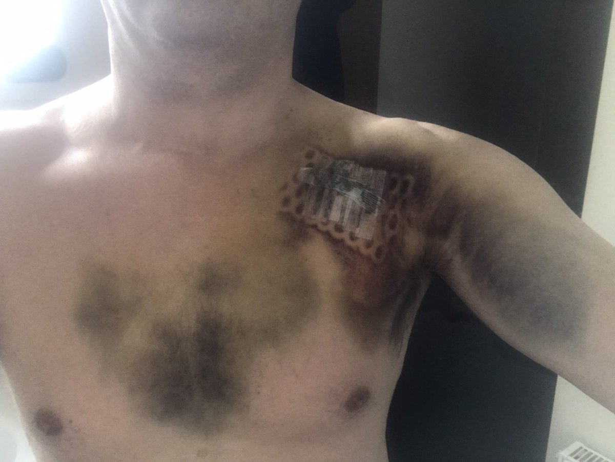 InMrMac's tweet photo. Crikey ….. 1st day back home and took a look to see how the healing is coming along #cardiacarrest https://t.co/o1y3jnm8bh