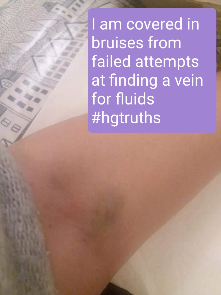 HyperemesisIE's tweet photo. What is it like to have hyperemesis?There's more to it than the stock images of women being sick in toilets! These photos are being shared with permission from women in our support group. #HGtruths #HGAD2021 #hyperemesis https://t.co/zLnKMtk8r5