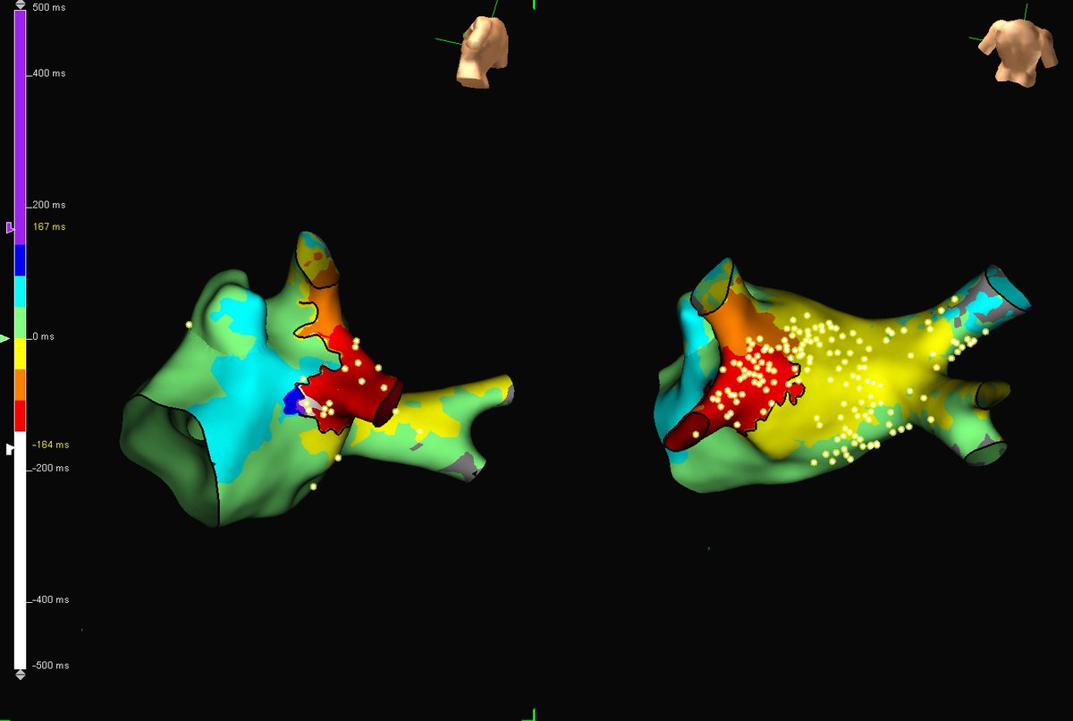 subparsonsmaps's tweet photo. A little #FridayFlutter action with @sheilapressley7. Patient had previous PVI ablation and presented in this atypical AFL at 340ms. @AbbottCardio #HDGrid #EPeeps https://t.co/FPh5oe1nIW