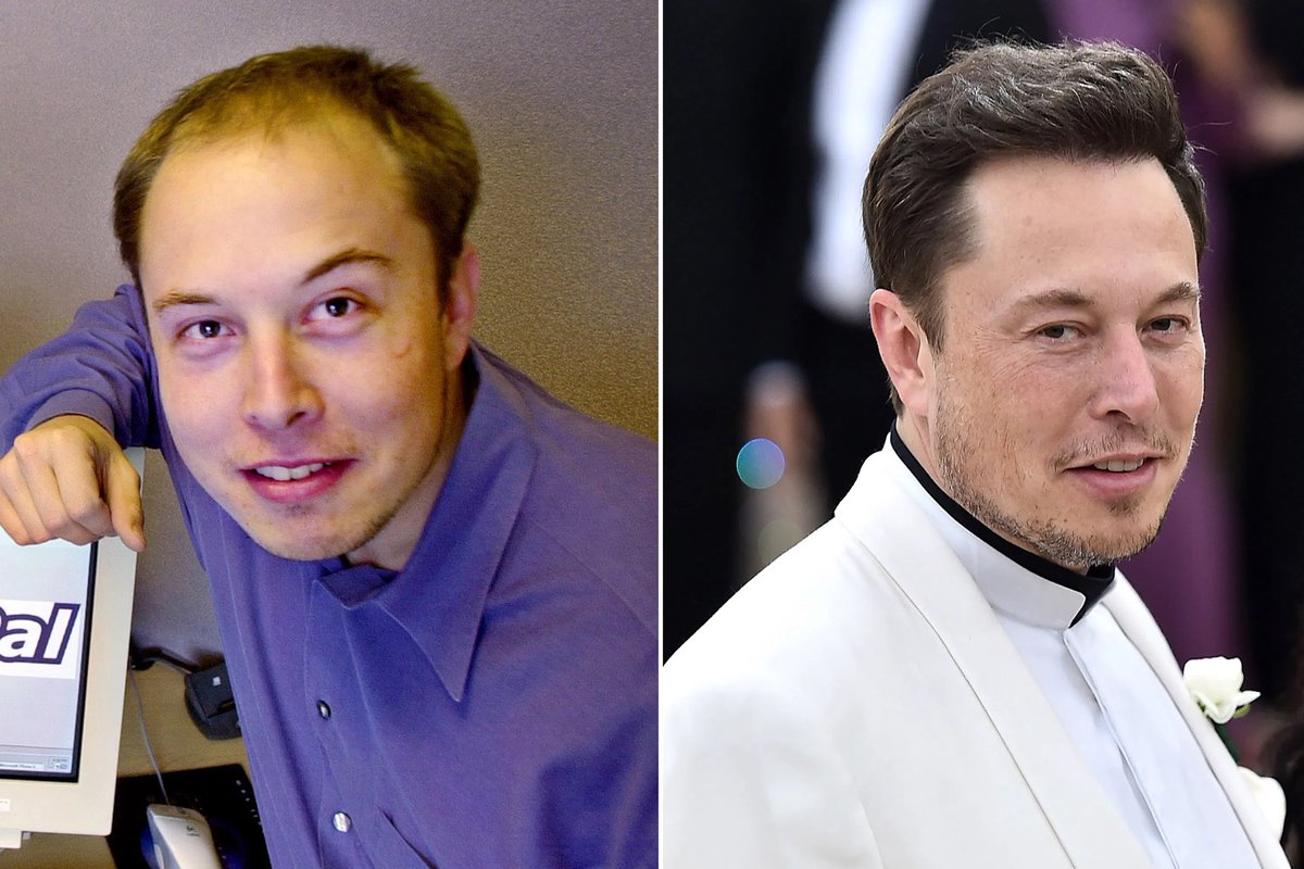 The greatest thing Elon Musk ever accomplished for humanity was fixing his hairline with implants.