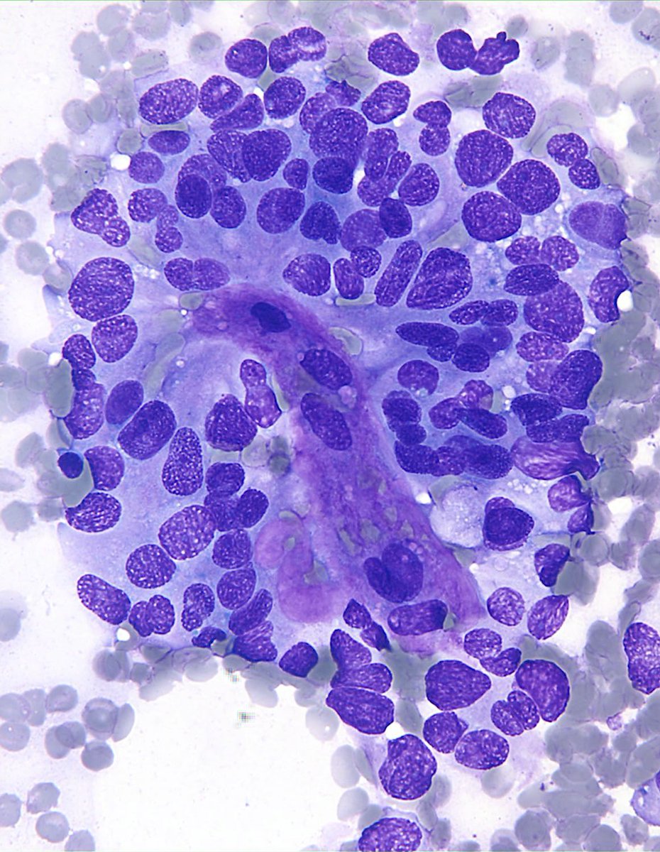 RT @sza_jhcyto: “Purple Peacock” -  Solid Pseudopapillary Neoplasm of the Pancreas. https://t.co/tWj5Hfr4fY