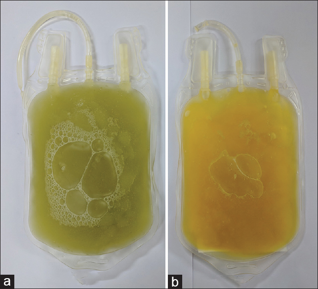 WBLMD's tweet photo. Blood (even venous) is red.

Plasma is yellow.

The plasma of women on oral contraceptives is slightly green, due to elevated #ceruloplasmin.

https://t.co/EDyfcbZz0w
https://t.co/i8e2moap52 https://t.co/k5bDZ3ob3U