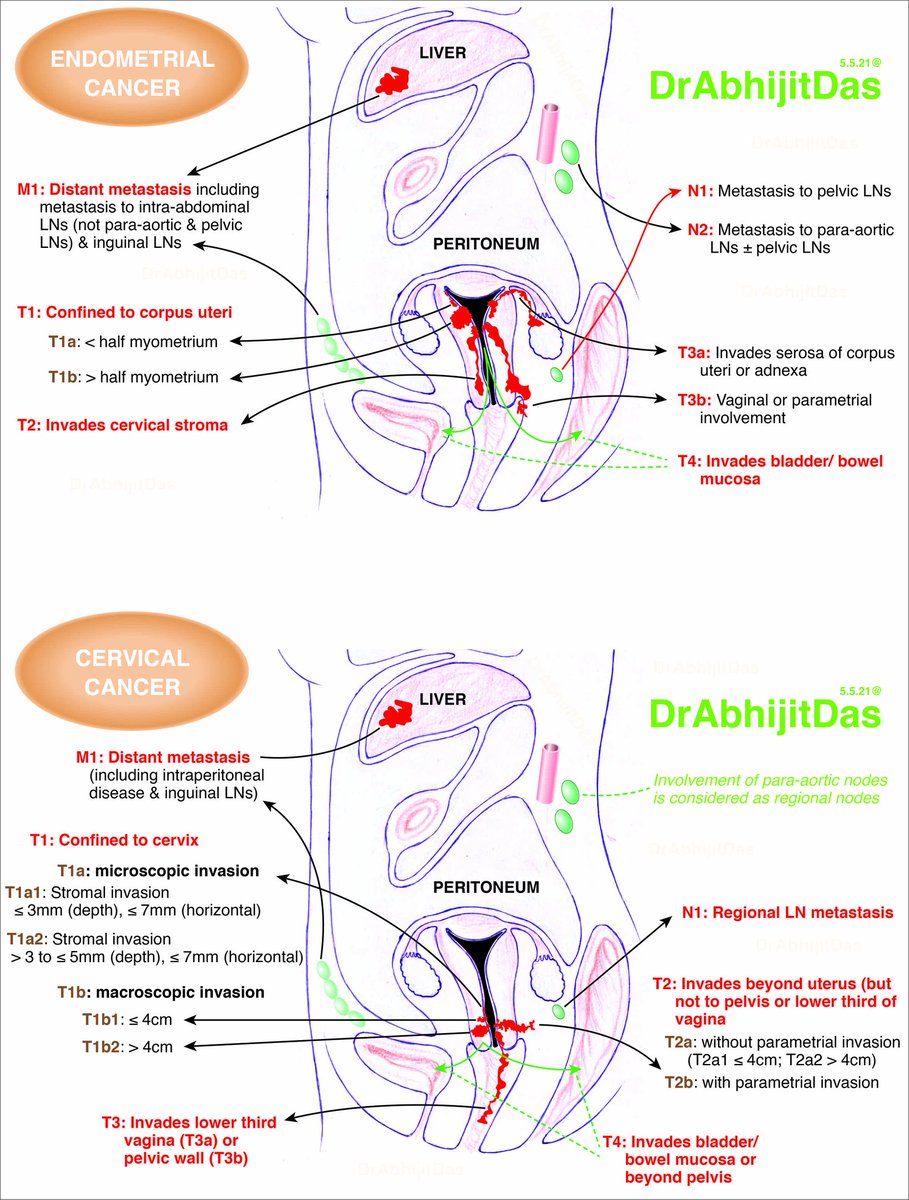 AbhijitSurgPath's tweet photo. Ovary, Endometrium, Cervix
TNM category: Basic facts for residents
2 interesting points: involvement of corpus uteri in cervical cancer and metastasis to para-aortic lymph nodes.
#MakeSurgiPathEasy
#BasicFactsForResidents
#FGTTNM https://t.co/hsPf5k8qi3