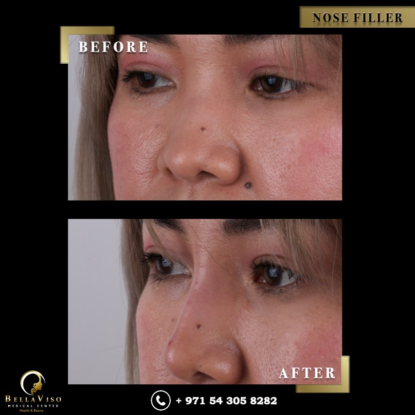 #BellavisoMedicalCenter #bellaviso #botox #botoxfiller #botoxcosmetic #botoxinjections #botoxbeforeandafter #botoxface #filler #fillers #fillerlips #fillersinjection #fillerbotox #aesthetics #aestheticsclinic