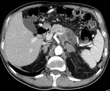 JoseLuisdelCura's tweet photo. El caso de hoy es sobre un sencillo gesto técnico que facilita un procedimiento habitual.
Se trata de un paciente con carcinoma de páncreas, en el que aparece una adenopatía retroperitoneal que capta moderadamente en el PET.
Abro hilo https://t.co/Ci0T4KvtAH