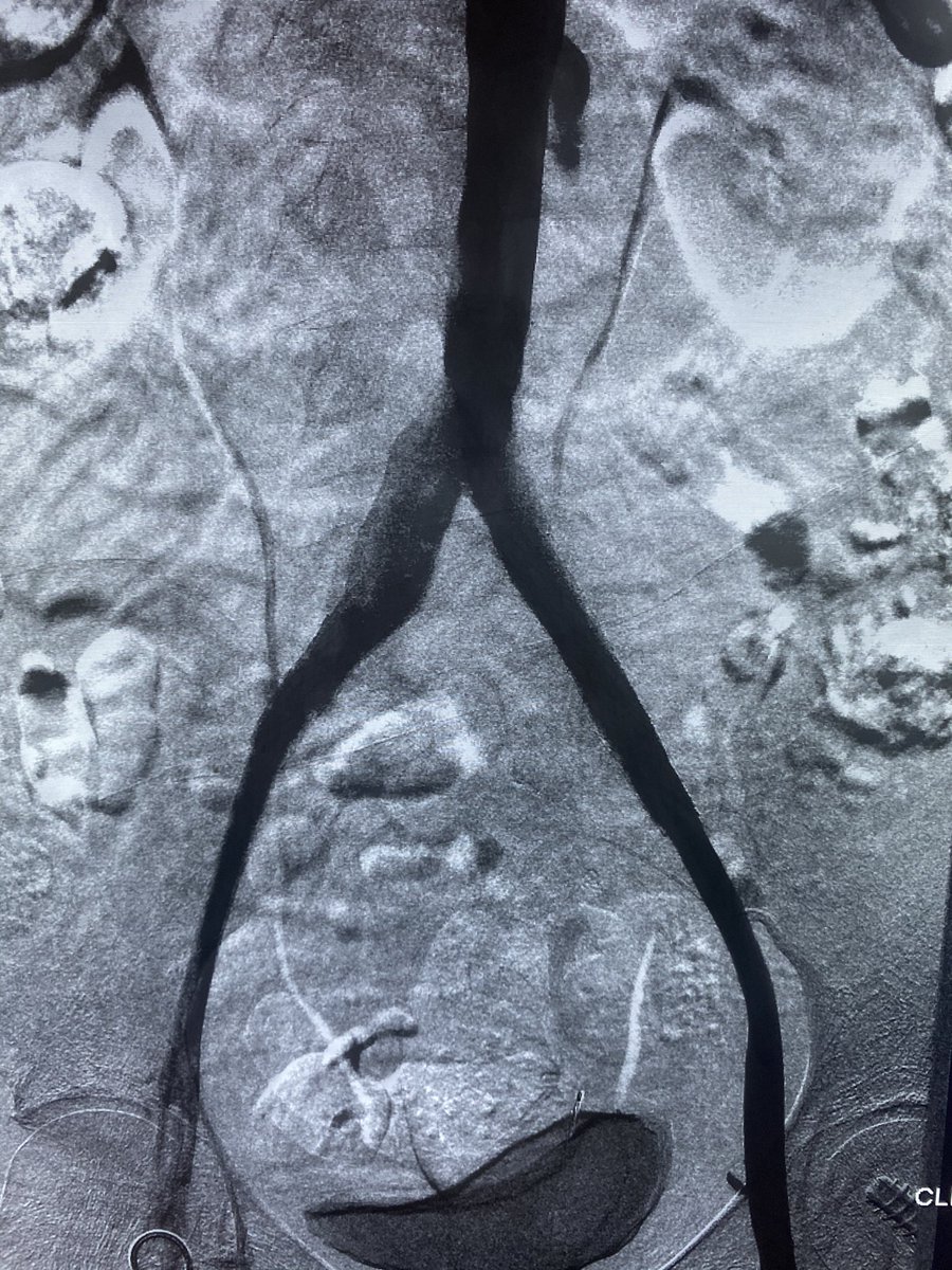 Consult for proximal DVT, with remote history of pelvic radiation for GYN malignancy.  Crossed long segment iliac venous occlusions, plasty, clottriever on the right, bilat stent reconstruction -> compression stockings -> DOAC -> home w improved symptoms. #iRad