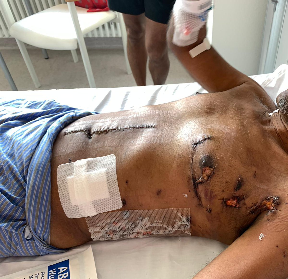 i_nashid's tweet photo. Anni asked me to share these photos with wveryone. They are as they are. Damage to the body is serious, but I feel the will has got stronger. @MohamedNasheed https://t.co/q66BkIvzpc
