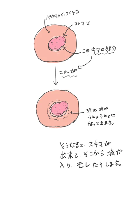 @tgjna 説明しにくいので図解で、小腸でストマ作るとこうなっちゃうんですよ(^^; 