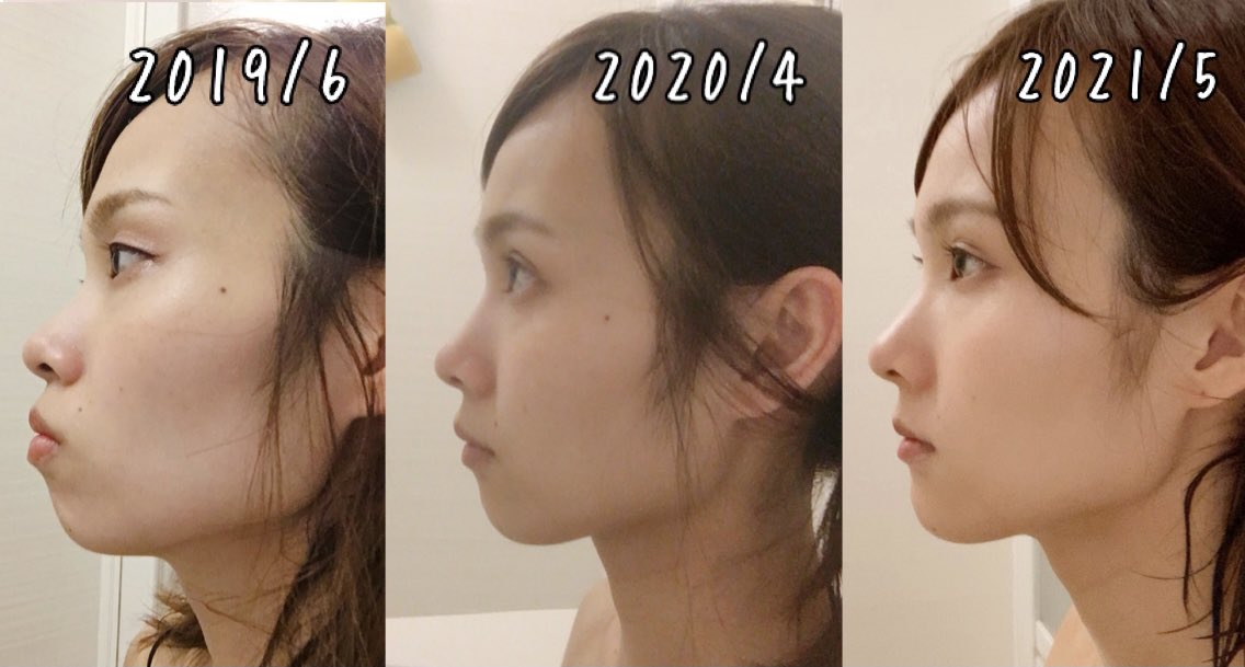 すず On Twitter 久しぶりに比較写真撮ったので今回は1年ずつで比べてみた 1枚目横顔 2枚目正面 3枚目頬こけの経過 抜歯矯正での 頬こけも多少残ってるけど気にならない程度になったよ 今年の冬にブラケット取れる予定なのであともう少しの辛抱だ 歯列