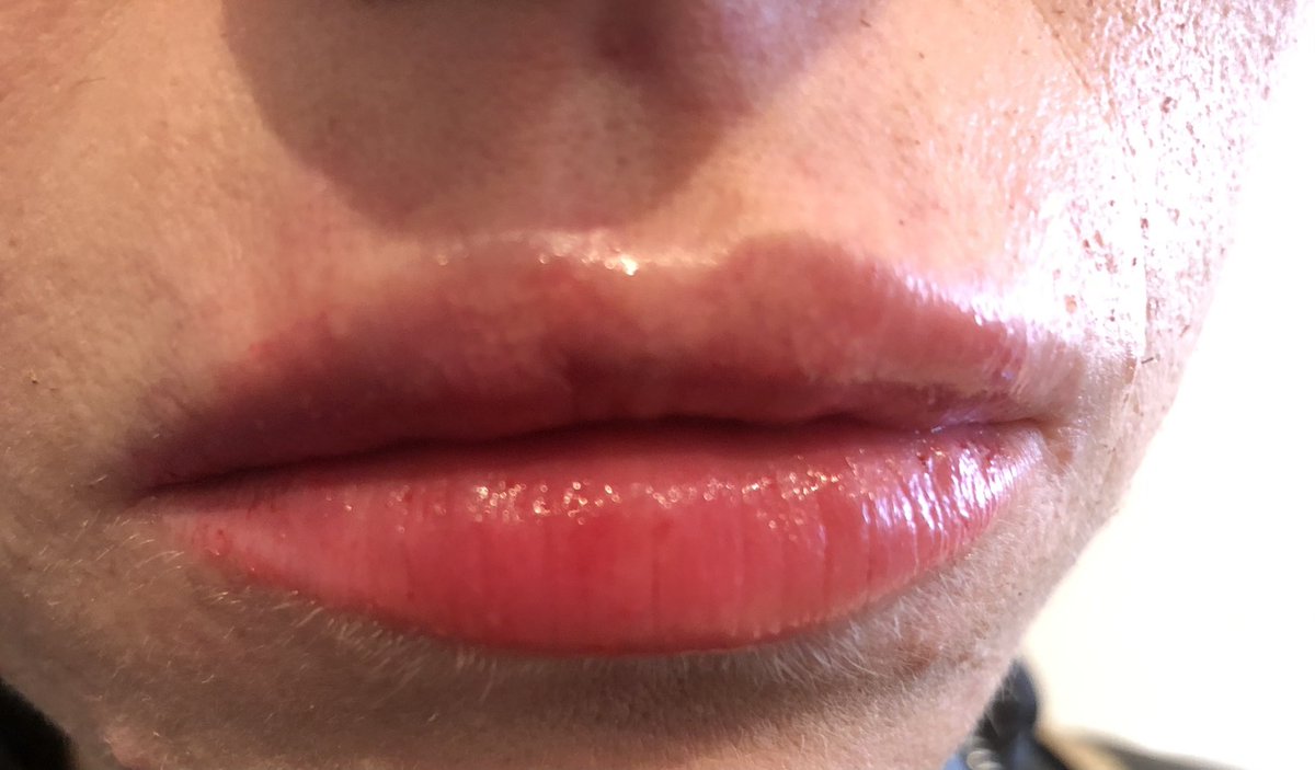 Hyaluron pen non needle filler at Wowbrows by zarish #Essex