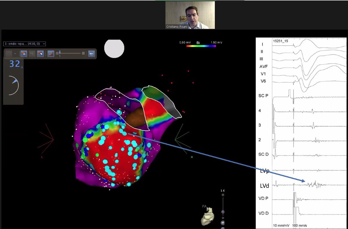 George Waits (@georgetweet4) on Twitter photo Dr. Pisani describing fragmented potentials using voltage mapping of VT in Chagas disease.
<a href="/aalahmadmd/">Amin Al-Ahmad, MD</a>
<a href="/JavierSanchezMD/">Javier Sanchez MD</a>
@scfuentesr
<a href="/Scanav1Mauricio/">Mauricio Scanavacca</a>
<a href="/crpisani/">Cristiano Pisani</a>
<a href="/KTamirisaMD/">Kamala Tamirisa MD</a>
<a href="/carlosrochitte/">rochitte</a>
@MiguelVldrbno
#EPeeps
#TCACCEP Dr. Pisani describing fragmented potentials using voltage mapping of VT in Chagas disease.
<a href="/aalahmadmd/">Amin Al-Ahmad, MD</a>
<a href="/JavierSanchezMD/">Javier Sanchez MD</a>
@scfuentesr
<a href="/Scanav1Mauricio/">Mauricio Scanavacca</a>
<a href="/crpisani/">Cristiano Pisani</a>
<a href="/KTamirisaMD/">Kamala Tamirisa MD</a>
<a href="/carlosrochitte/">rochitte</a>
@MiguelVldrbno
#EPeeps
#TCACCEP