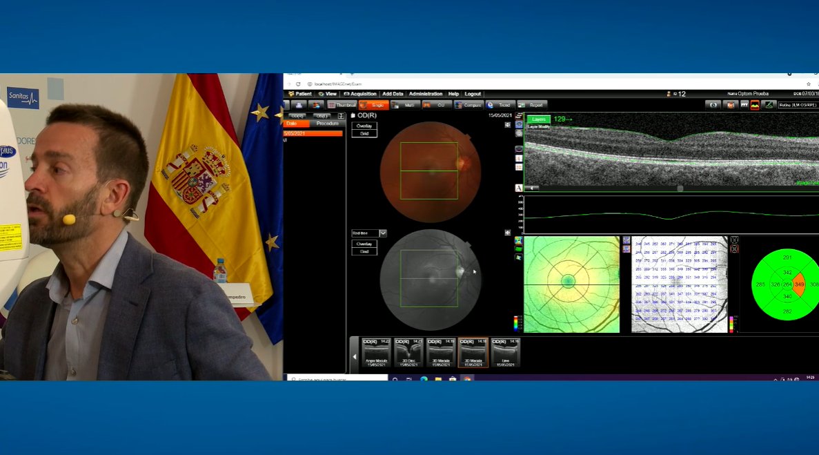 OPTOMcongreso's tweet image. 👨🔊🔬👁️ Una vez adquiridos todos los valores, se realiza la interpretación de las cifras obtenidas a través de las imágenes capturadas.  

#Retinografía #Autofluorescencia #Retina #Mácula #Espesor #Fóvea 

#OPTOM21
