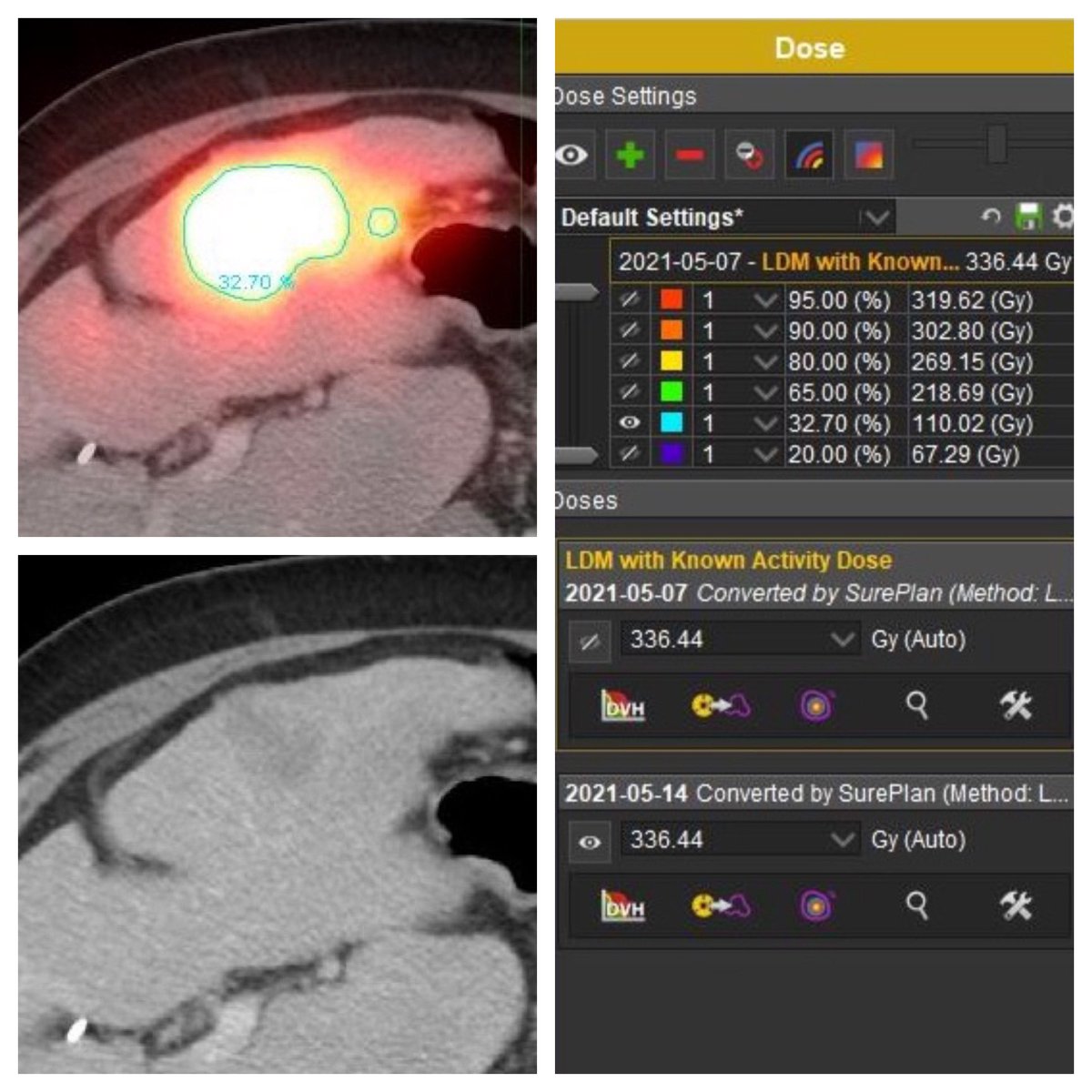 Creating “kill zone” dosimetry outline with MIM Software using post y90 bremsstrahlung imaging is a great way to show referring providers immediate results. Awesome way to show the ‘surgical-like margins’ in radiation ☢️ segmentectomy cases <a href="/DieHCCDie/">Ed Kim</a> #irad <a href="/MountSinaiIR/">Mount Sinai IR</a> <a href="/JTassMD/">Jordan Tasse</a>