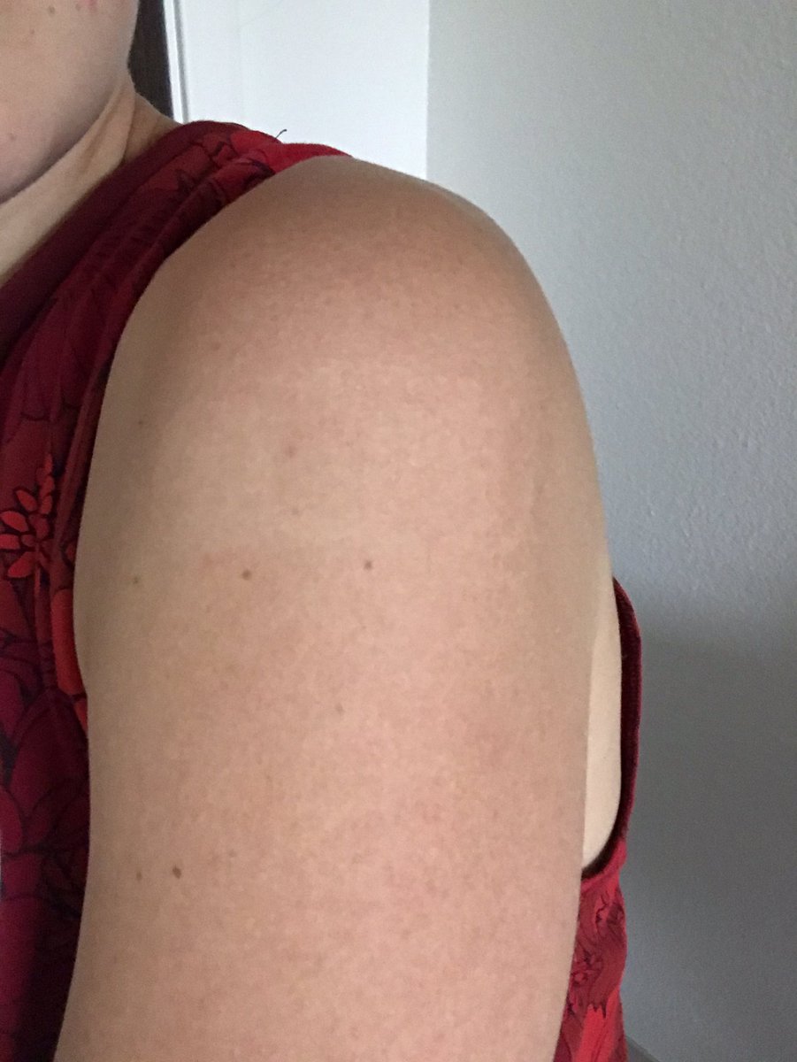 cmattson_18's tweet photo. I got my 2nd covid shot on March 8th... just over 2 months later I’ve decided to take to Twitter to report the very serious side effects I’ve experienced...... FROM THE BANDAID LMAOOOOO why is there still a pale spot 😭 #bandaidgate #sharingmytruth https://t.co/NnP5fIEN7j