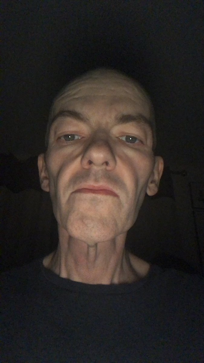 AnfractuousOne's tweet photo. #Cancer does this! Late night/early morning selfie post de-big footing! Beard gone, swollen feet are here to remain at present I’m afraid! https://t.co/LfmPwqDMuz