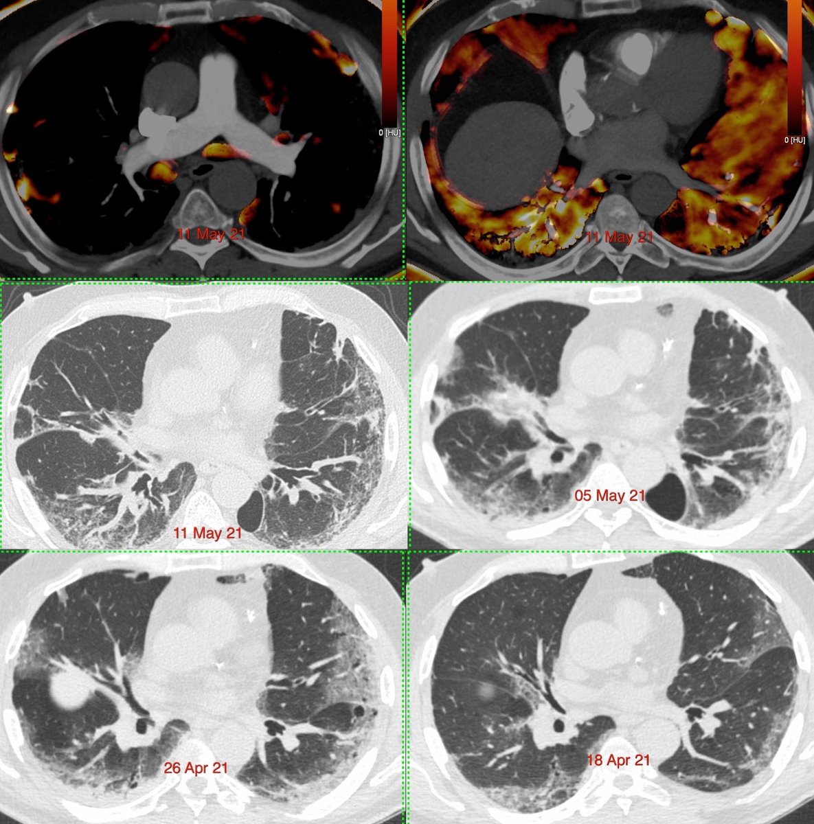 Case: Covid-19 angiopathy with perfusion defects without pulmonary thromboembolism
ctchestreview.com/covid19fibrosi…
#covid19 #covidangiopathy #ctpa #radtwitter #lungtwitter