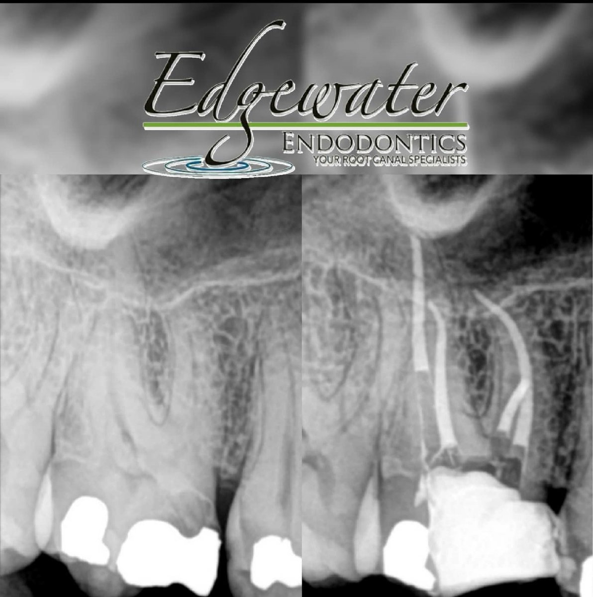 EWEndodontics's tweet photo. Edgewater Endodontics Case of the Day:
Tooth #3

https://t.co/DUAs6UToGg https://t.co/WeyIJ2hN9e
