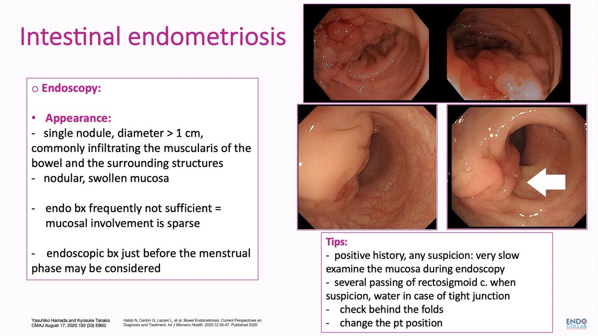Como se cura la endometriosis