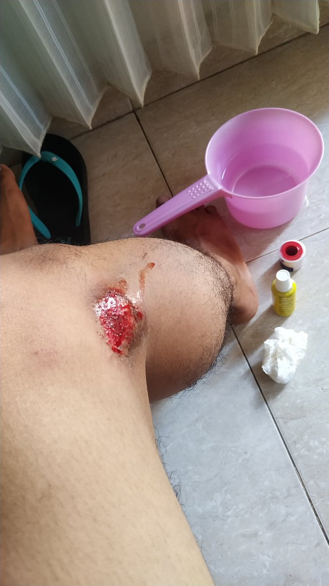 Jatuh pagi pagi, lukanya di luka yg baru sembuh, soe apa artinya itu?