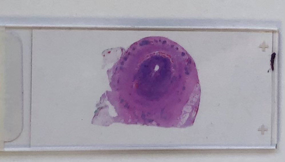 #GIpath #LPpath #Pathresidents

Anyone want to speculate on the organ, and possible diagnoses?

Give it a guess, the scroll down for microscopic correlation & discussion in the replies.