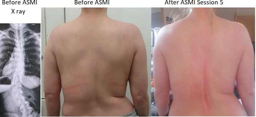 Non-surgical #scoliosis treatment with the ASMI