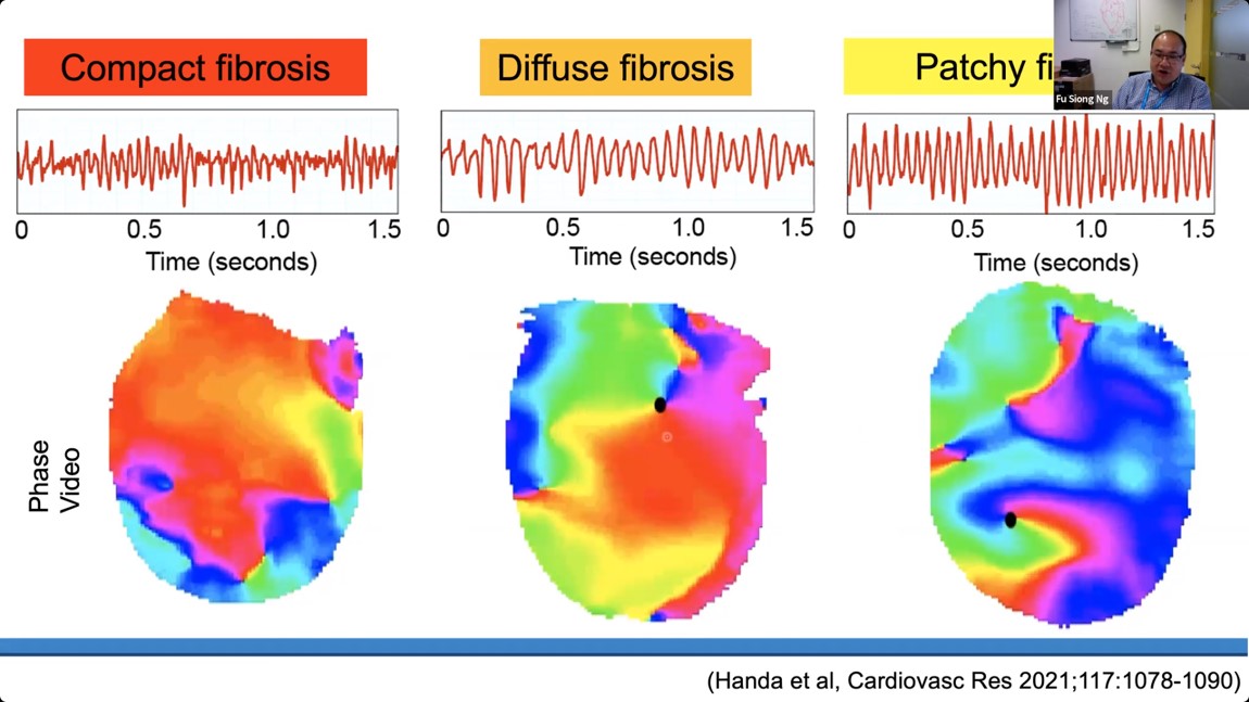 Thanks @DrFuSiongNg, for your exciting #TARM talk on #electrophenotypes and #arrhythmias.
@Dr_GwilymMorris @DrKaranSaraf @MappingLab_EP 
#AFib #EPforum #AFablation