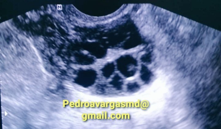 PedroVargasMD's tweet photo. ¿Cuales son los criterios ecograficos más eficaces para diagnosticar el Sindrome de Ovario Poliquistico? https://t.co/AqEgkBSLFZ