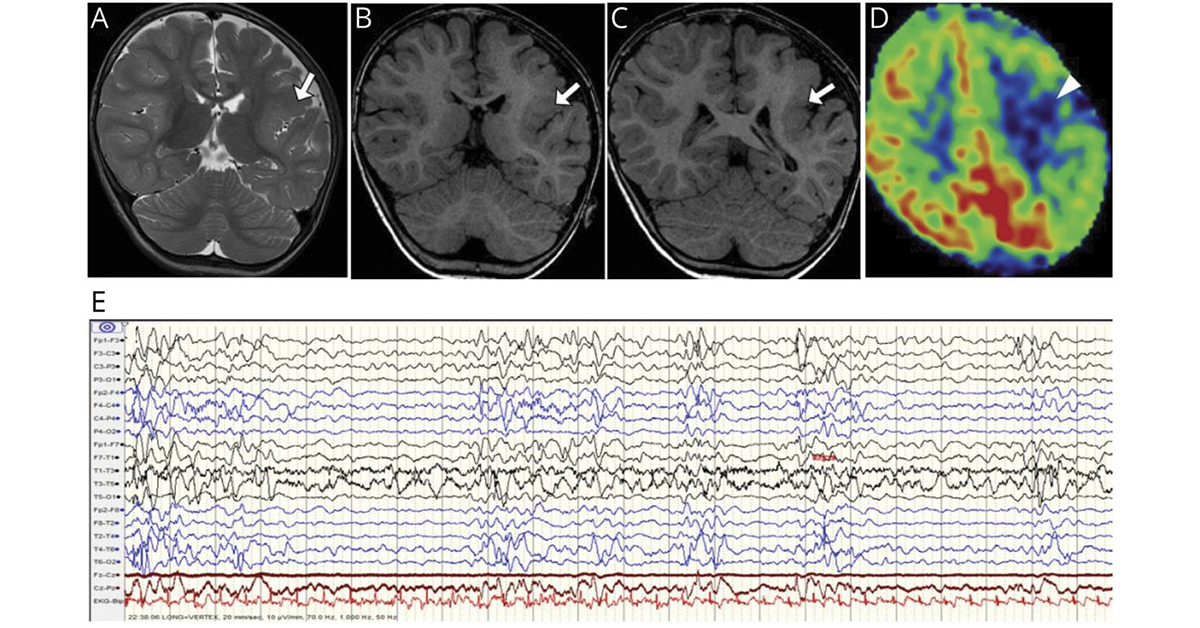 GreenJournal's tweet photo. Teaching NeuroImages: Ohtahara Syndrome due to Unilateral Perisylvian Polymicrogyria https://t.co/PJby0DXbVF #Neurology #NeurologyRF https://t.co/oikwruHLGd