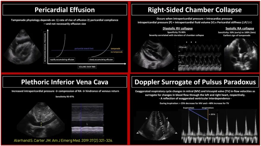 NephroP's tweet photo. Good old #POCUS #echofirst flashcards for evaluation of pericardial effusion https://t.co/8FGw8DCXa8