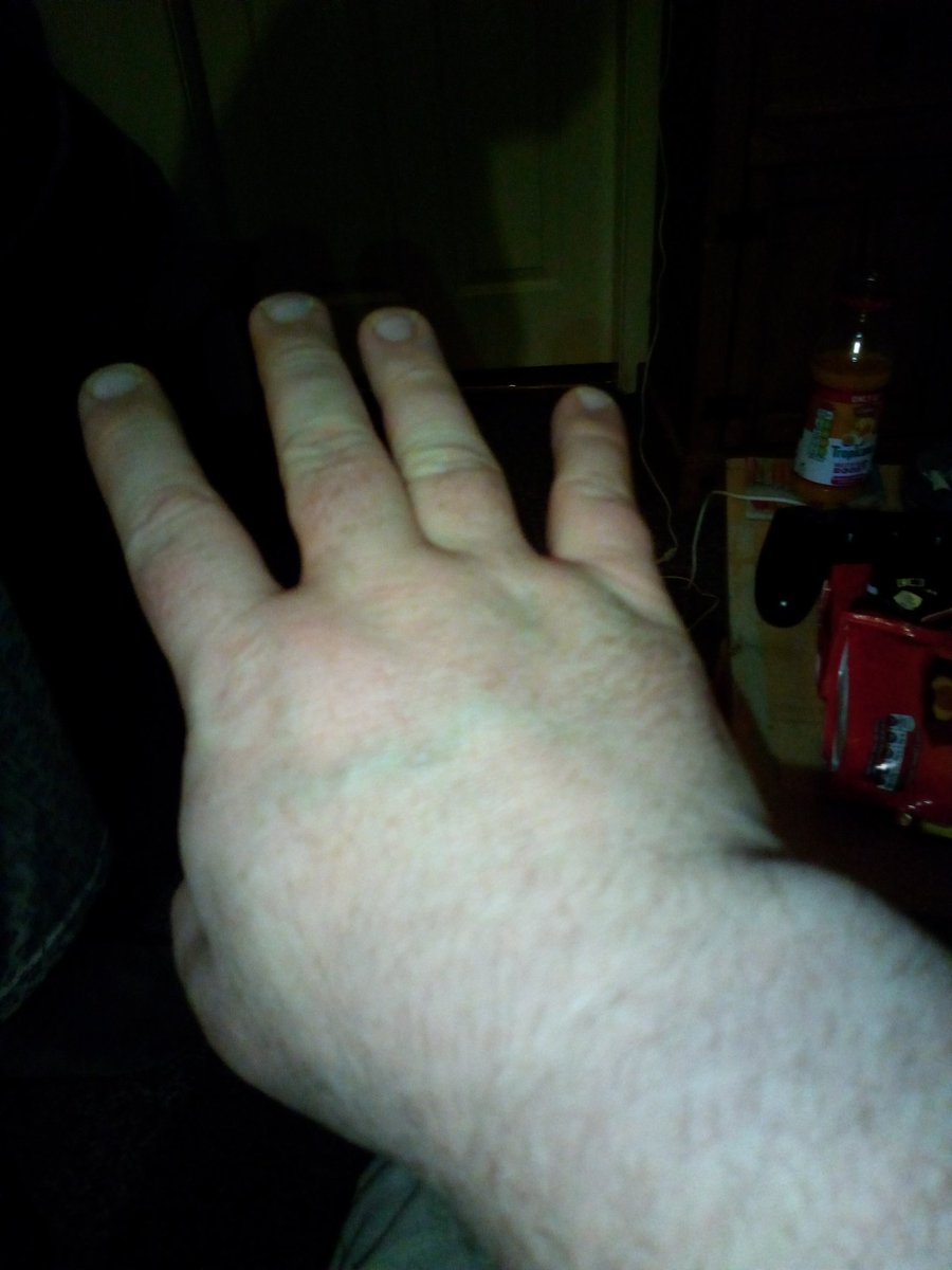 WayneKelly's tweet photo. Looks like my hand is busted happened on way to McColl's yesterday fell down like a sack of spuds street away from the shop itself and now can't hardly move my hand so looks like it's the a&amp;e time today https://t.co/CrsoFZEoSc