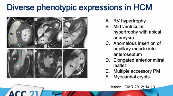 #HCM phenotypes you can see on #whyCMR 
🧲 RV hypertrophy 
🧲 Mid ventricular HCM with apical aneursym 
🧲 Anomalous Papillary Muscle insertion 
🧲 myocardial crypts 
🧲 Long AML 
🧲 Accessory PM 
#ACC21 

Source: 
jcmr-online.biomedcentral.com/articles/10.11…