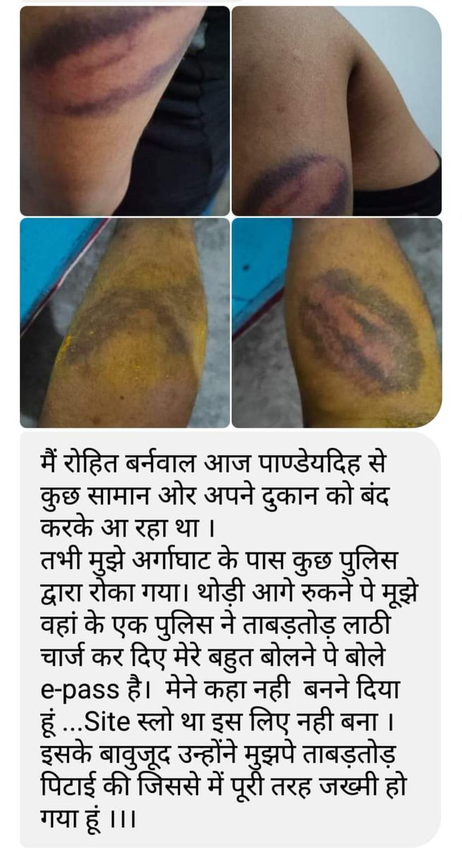 ShivamB42913594's tweet photo. सभी के लिए सर दर्द बन रही ई-पास व्यवस्था।गिरिडीह प्रशासन द्वारा इस तरह की पिटाई कहां तक उचित है। आखिर सरकार क्या चाहती है।झारखंड सरकार को सबसे पहले कोई वैकल्पिक व्यवस्था करनी चाहिए। आखिर इमरजेन्सी में लोग क्या करेंगे? मुख्यमंत्री हेमंत सोरेन जी ऐसे अधिकारियो पे कड़ी करवाई करे । https://t.co/BJEXh9F1Jy