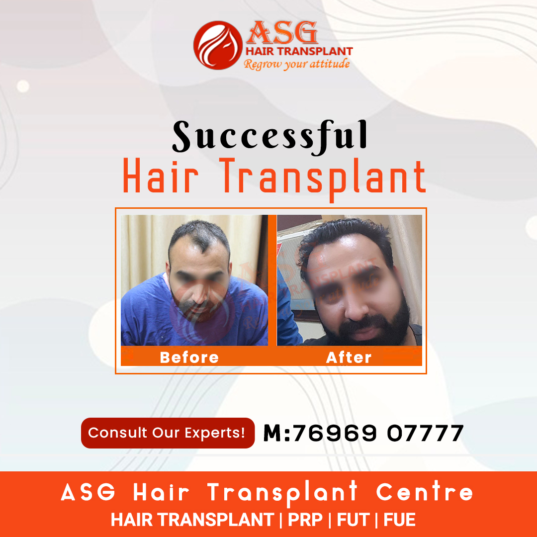 AG Clinics  best hair transplant clinic in jalandhar hair transplant in  jalandhar biostimulated fue in jalandhar