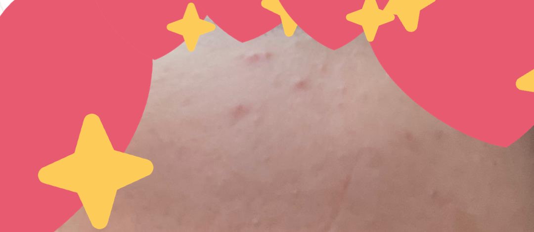 SyuhadaSuhain1's tweet photo. Scars syu slowly fade. Mimpimika serum dgn zarzou I pakai setiap hari. Harini zarzou, esok mimpimika gitu. Best. Make up pun tak cakey dah hehehehe love my skin rn :) https://t.co/tF6IYizVeh