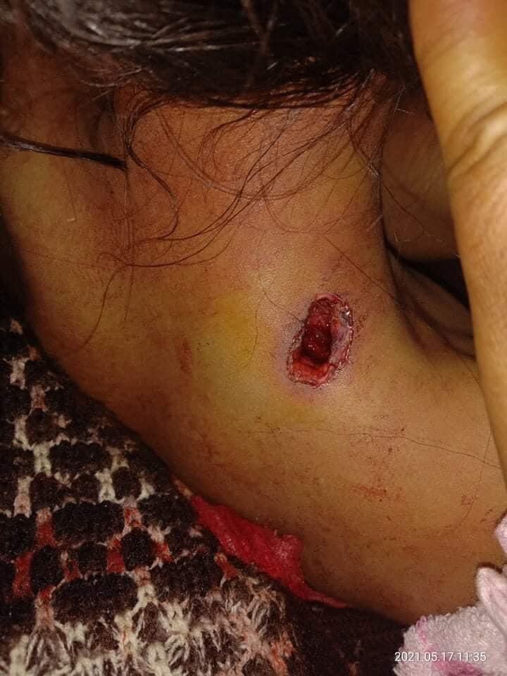 10 years old kid who's trying to hide in home shot by military junta in Mindat, Chin state. There is no medical suppliers and helps. She needs emergency cares right now. #stopkillingourchildren #WhatsHappeningInMyanmar #May17Coup