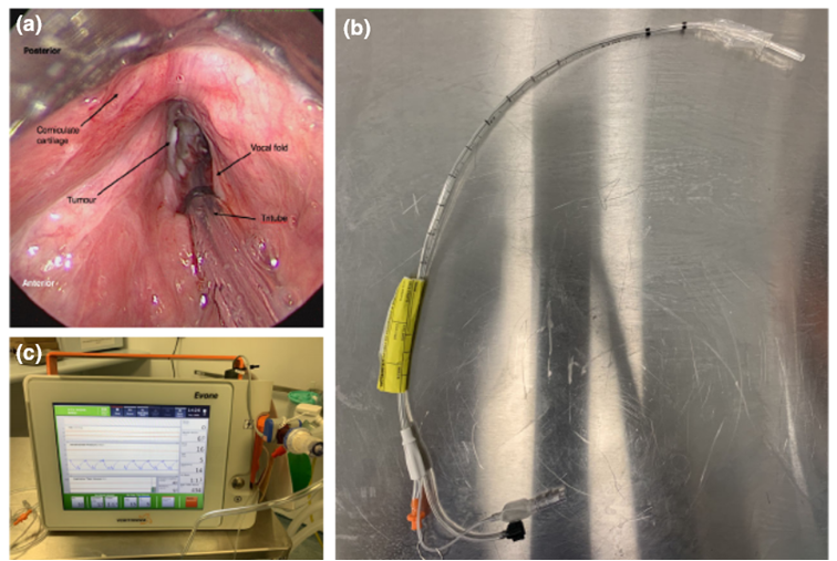 The ultrathin tritube,with Evone, enabled curative en bloc resection of an advanced transglottic tumour in the setting of acute airway obstruction, with excellent gas exchange and a good surgical view, while avoiding multiple extubations,apneic periods and emergency tracheostomy.