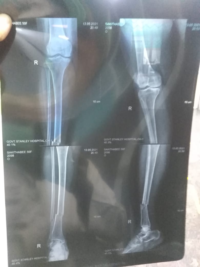Bhadhu7Md's tweet photo. Hon.@CMOTamilnadu Iyya Vanakam...My Aunt Was Accident Yesterday In https://t.co/Lvb7HQ0IGJ.operative lorry
She admitted in @NewHopeHospital They Asking 3laks for surgery they unable to pay this much of money...so kindly Do help them From Government fund pls help them Iyya... https://t.co/lxs48vMFLM